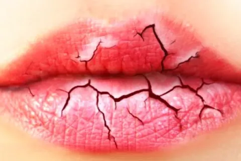 Penyebab Bibir Kering Pecah pecah Bagaimana Cara Mengatasinya