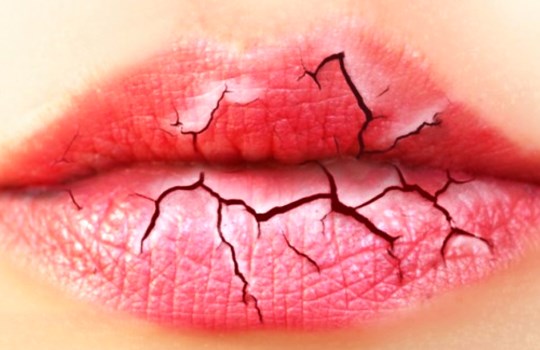 Penyebab Bibir Kering Pecah-pecah dan Cara Ampuh Mengatasinya