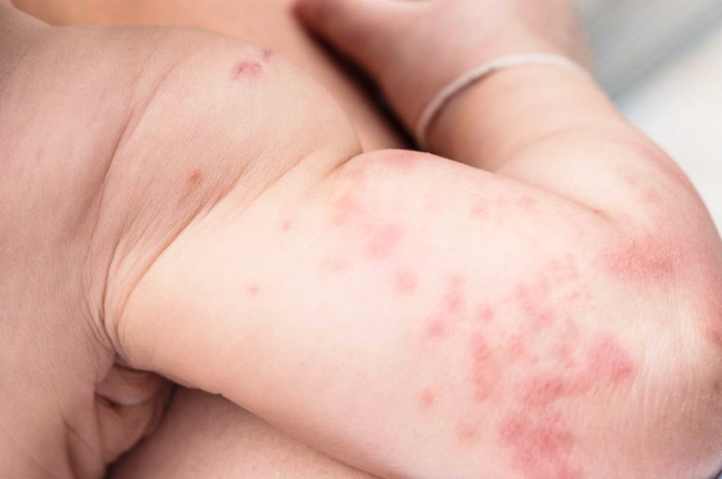 Gejala Atopic Dermatitis