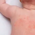 Mengenal Atopic Dermatitis, Gejala dan Cara Mengatasinya