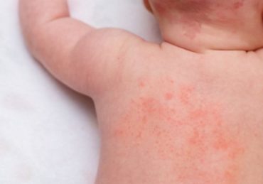 Mengenal Atopic Dermatitis, Gejala dan Cara Mengatasinya