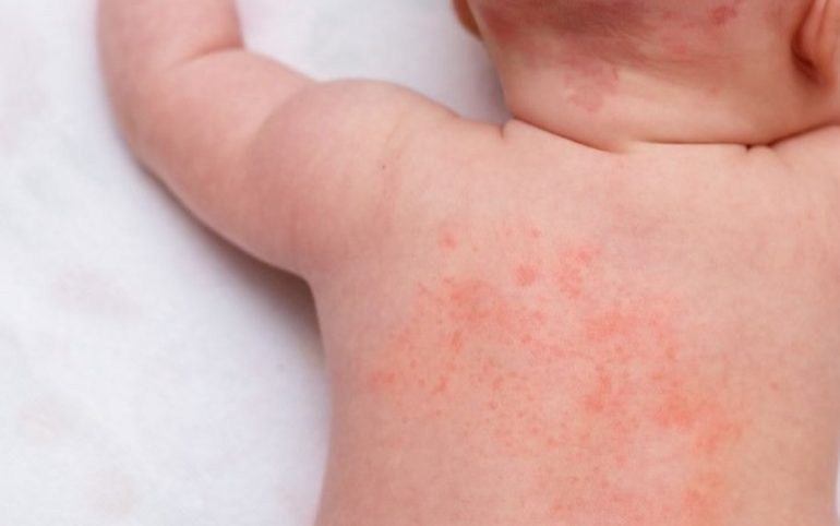 Mengenal Atopic Dermatitis, Gejala dan Cara Mengatasinya