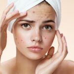 7 Tips Memilih Masker untuk Kulit Berjerawat yang Perlu Diketahui