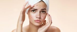 Tips Memilih Masker untuk Kulit Berjerawat yang Perlu Diketahui