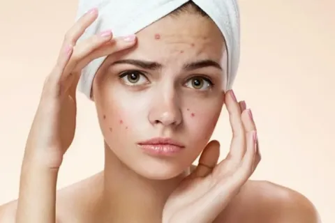 Tips Memilih Masker untuk Kulit Berjerawat yang Perlu Diketahui