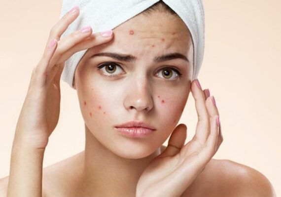 Tips Memilih Masker untuk Kulit Berjerawat yang Perlu Diketahui