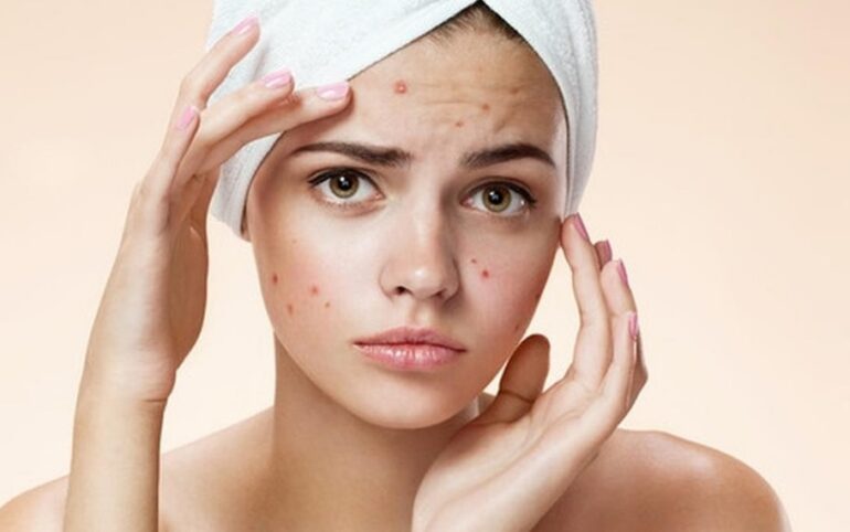 Tips Memilih Masker untuk Kulit Berjerawat yang Perlu Diketahui